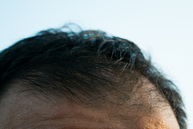 男性型脱毛症の男性の頭髪