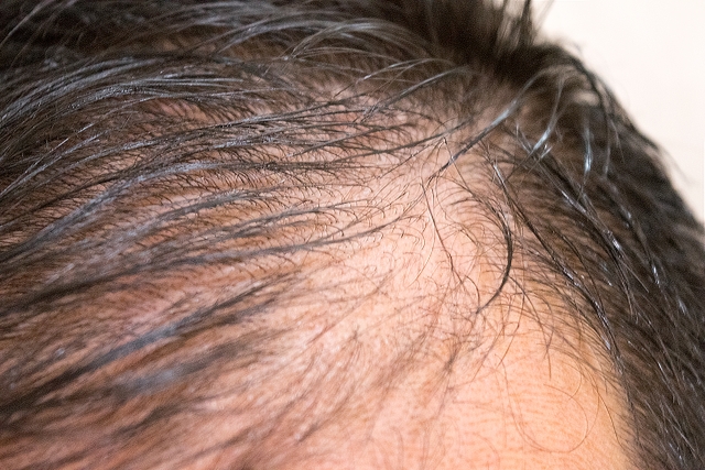 男性型脱毛症（AGA）の男子にチャップアップは即効性が求められるのかをaoriyaen.comが解説