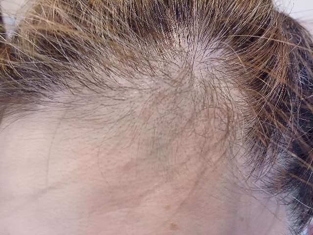 ヘアバースサプリメント使用前の生え際（そりこみ部）のアップ画像