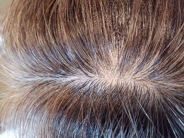 ヘアバースを4ヶ月間飲み続けた分け目の状態（少し効果の予兆があらわれてきた）