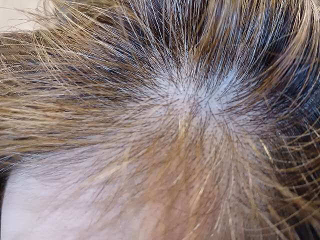 ヘアバースサプリメント６ヶ月使用し生え際（そりこみ部分）に髪が生えてきた