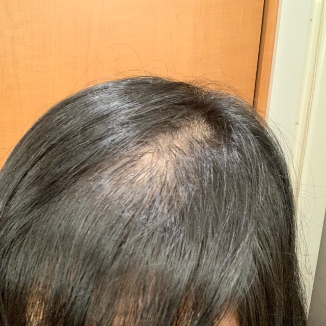 女のつむじはげって治る 女性の薄毛原因から髪型で隠す方法を解説 あきブログ ヤエン釣り情報サイト