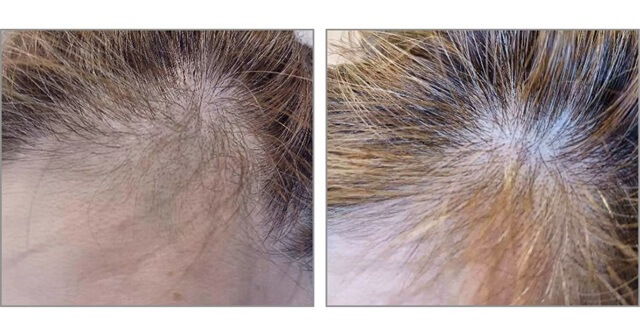 ヘアバース飲み始めと6ヶ月後の生え際部（そりこみ部）のビフォーアフター