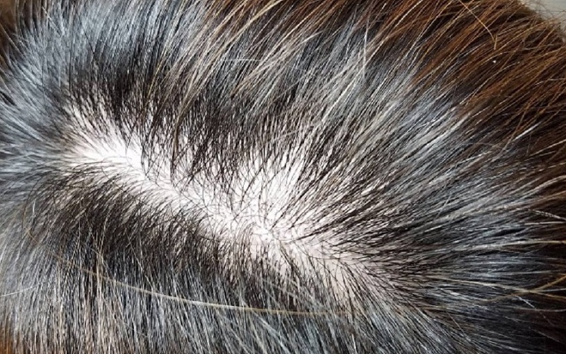 ヘアーバースサプリ6ヵ月服用後の頭髪状態