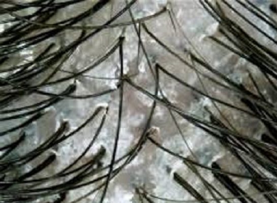 荒れて表皮が捲れた頭皮画像(haruシャンプー使用前の頭皮状況)