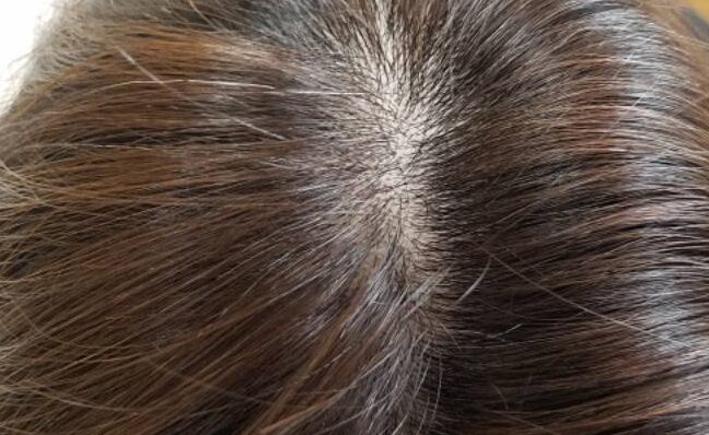 ミューノアージュ育毛剤使用9ヶ月目のれいさんの薄毛状況