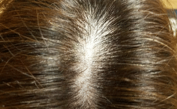 ミューノアージュ育毛剤を12ヶ月使用した40代女性の薄毛改善動画