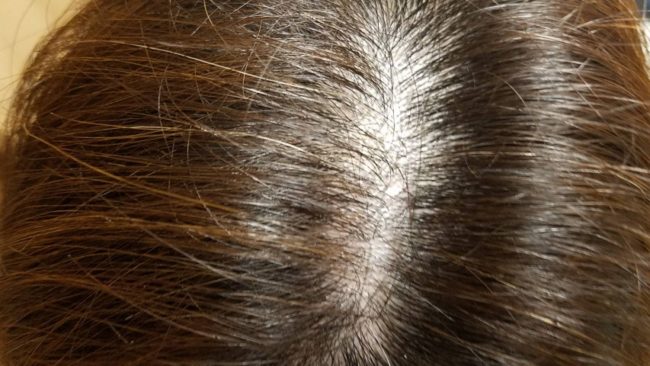 ミューノアージュ育毛剤使用6ヶ月目のれいさんの薄毛状況