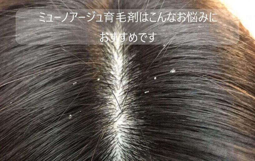 ミューノアージュ育毛剤が効果ある脱毛症を紹介
