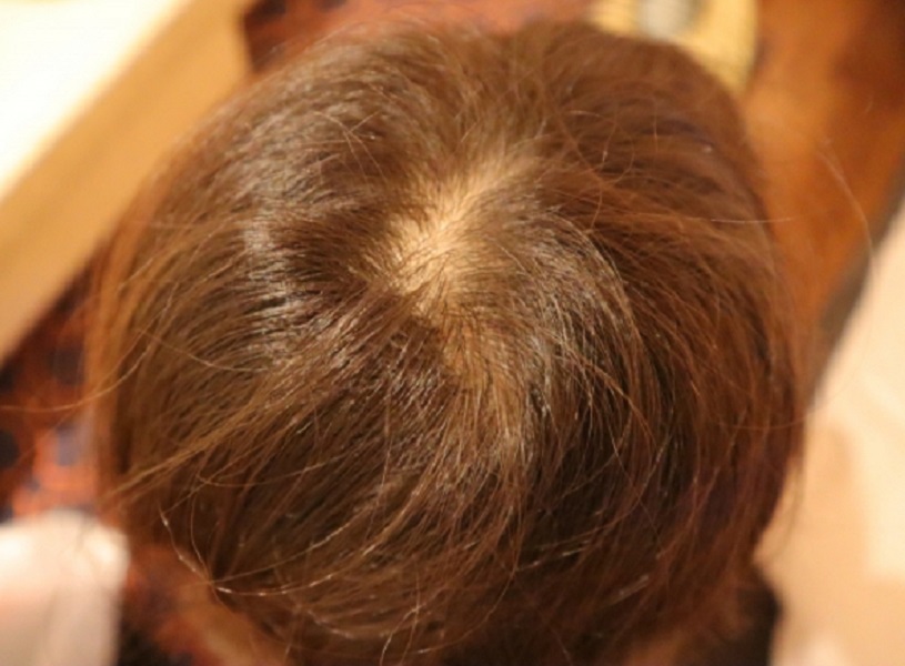 女性型脱毛症（FAGA）の女性