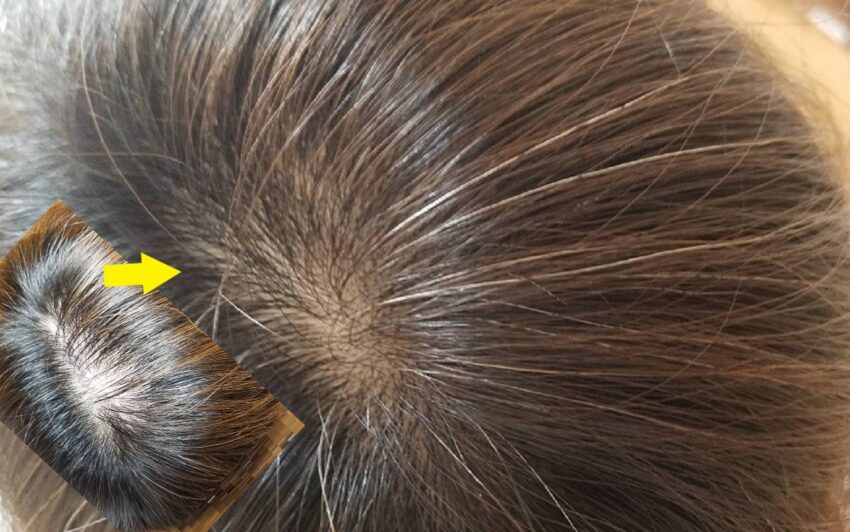 ヘアーバースサプリメント12ヵ月服用した頭髪状態