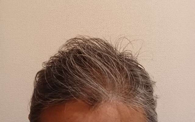 ニューモⅤを6ヶ月使用し生え際の薄毛が改善