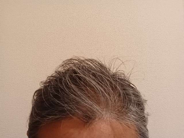 ニューモⅤを6ヶ月使用し薄毛が改善した頭髪