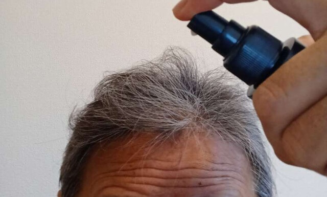 ニューモV育毛剤を3ヶ月使用した生え際～頭頂部の状態