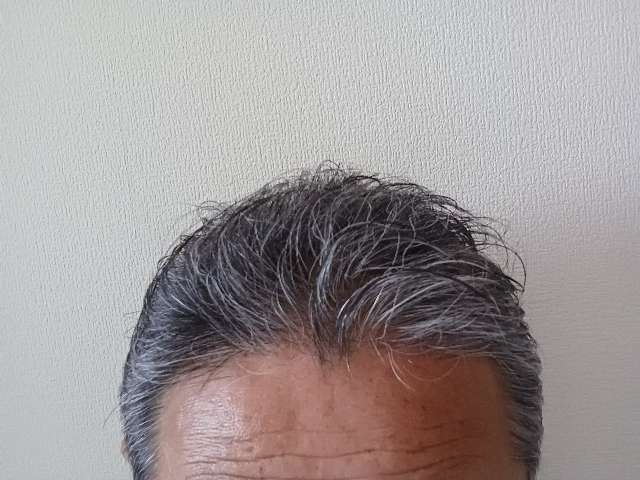 ニューモVを６ヶ月使用した生え際から頭頂部