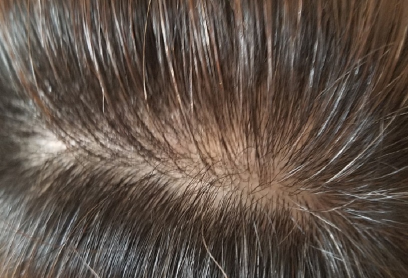 女のつむじのはげって治る 女性の薄毛原因から髪型で隠す方法を解説 あきブログ ヤエン釣り情報サイト