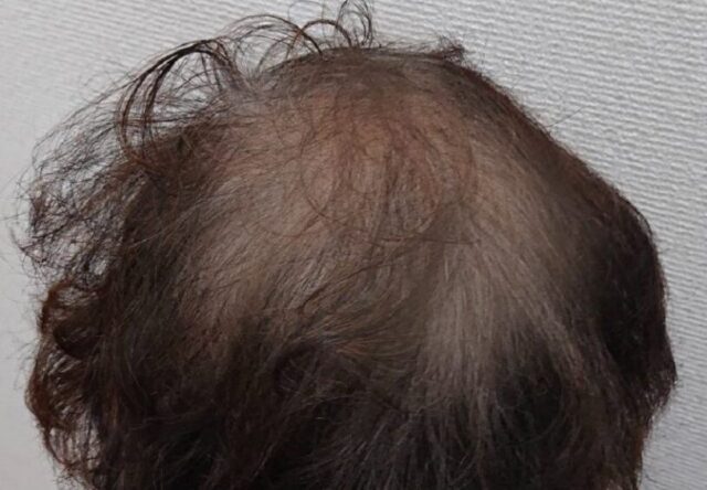 ラミナス育毛剤の使用に適している薄毛