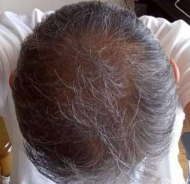 ヒックスミノキシジル3ヶ月使用