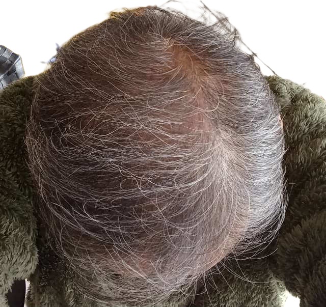 ヒックスミノキシジル使用4ヶ月使用