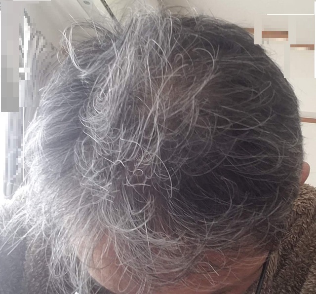 ヒックスミノキシジル6ヶ月使用