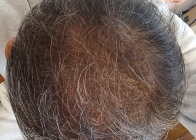 ヒックスミノキシジル5を使用し2～3ヶ月目の頭皮写真