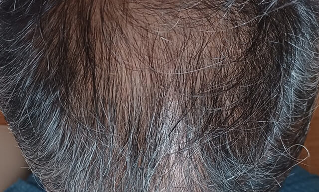 ヒックスミノキシジル使用前の頭皮写真