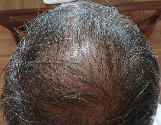 【写真あり】ヒックスミノキシジル5は生えない？4ヶ月使った効果と副作用を暴露