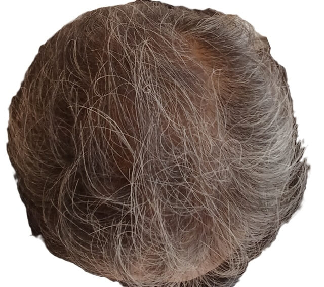 チャップアップ使用して6ヶ月以上(1年)の生え際から頭頂部