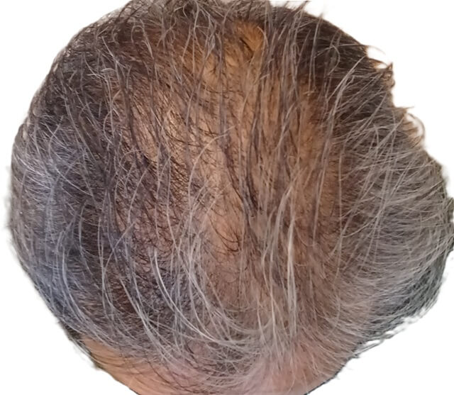 チャップアップ使用しはじめの頭頂部から生え際