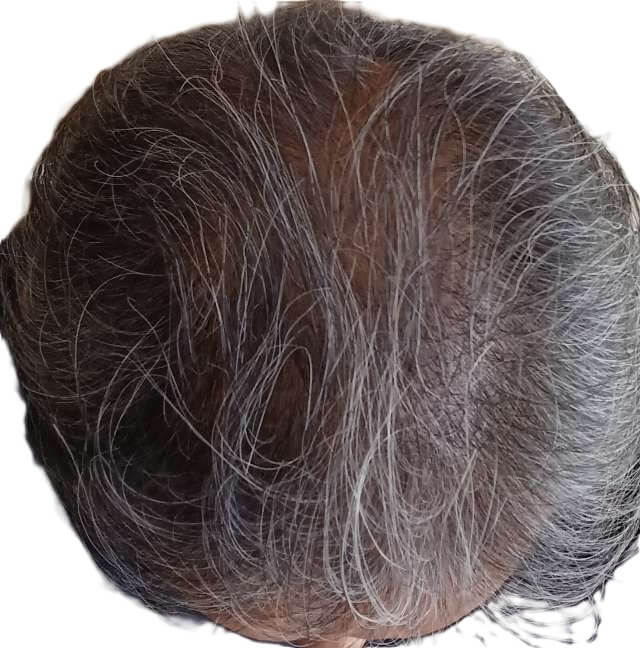 チャップアップ使用5ヶ月後の頭頂部から生え際