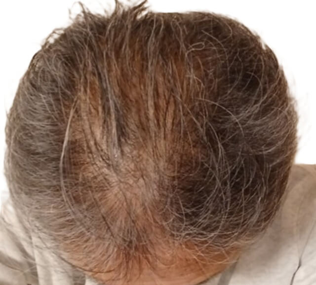 チャップアップ使用3ヶ月後の頭頂部から生え際