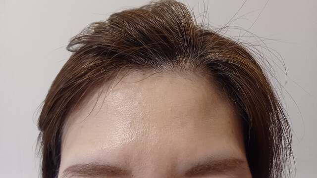 ラミナス育毛剤使用後3ヶ月目の生え際