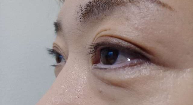 色素沈着はする？成分の安全性と旧版とリニューアル版（ラシックユープラス）の違いを解説