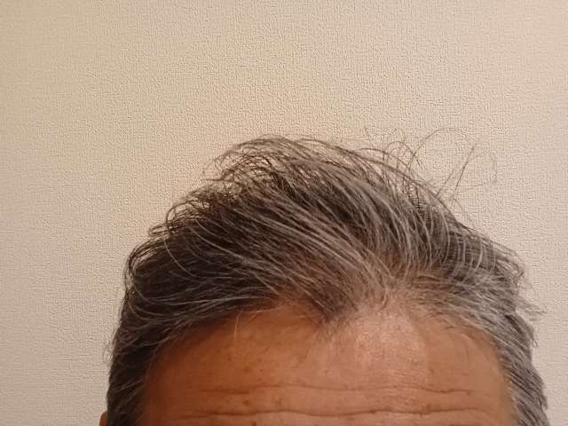 リデンを3ヶ月継続した頭皮と頭髪