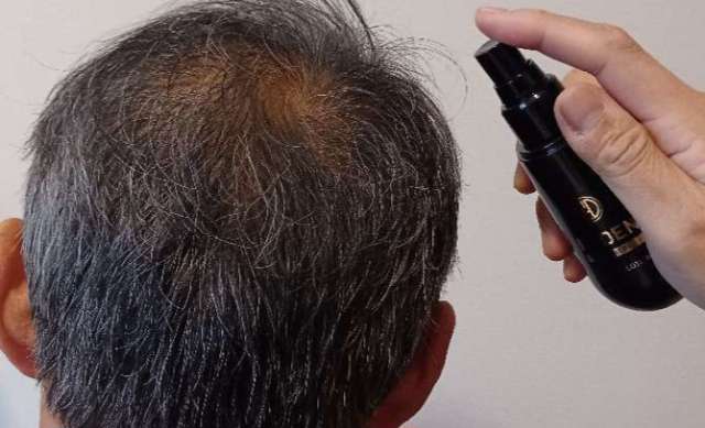 リデンを生え際に使用している