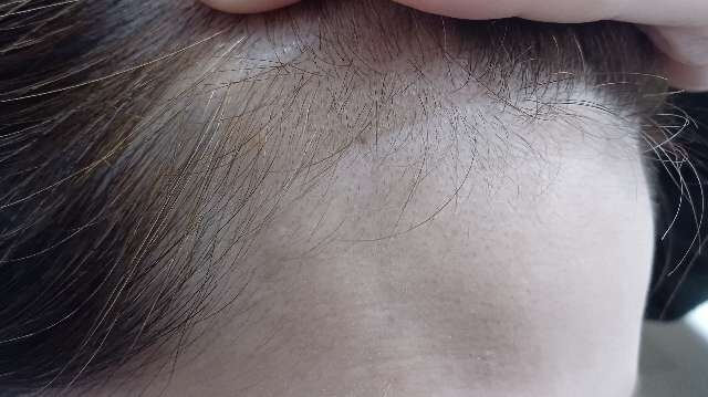 ビーリスラリッチスカルプ使用前の生え際