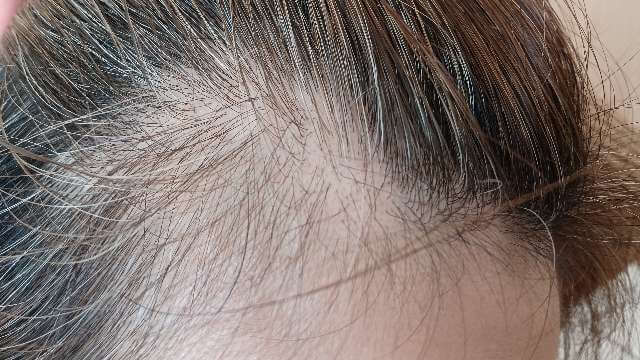 ラリッチスカルプ1ヶ月使用した生え際部分の写真