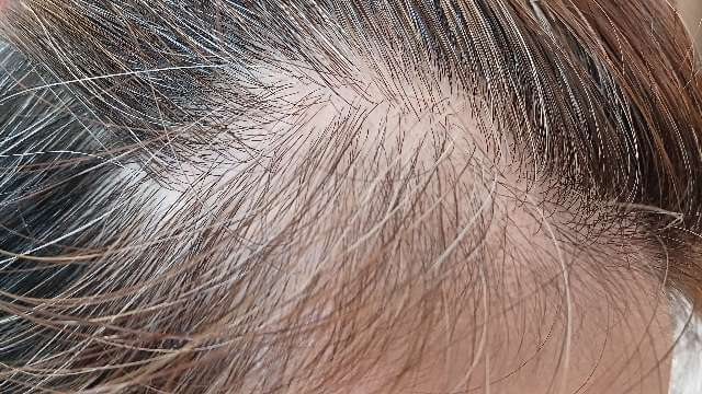 ビーリスラリッチスカルプ3ヵ月使用後の生え際の写真