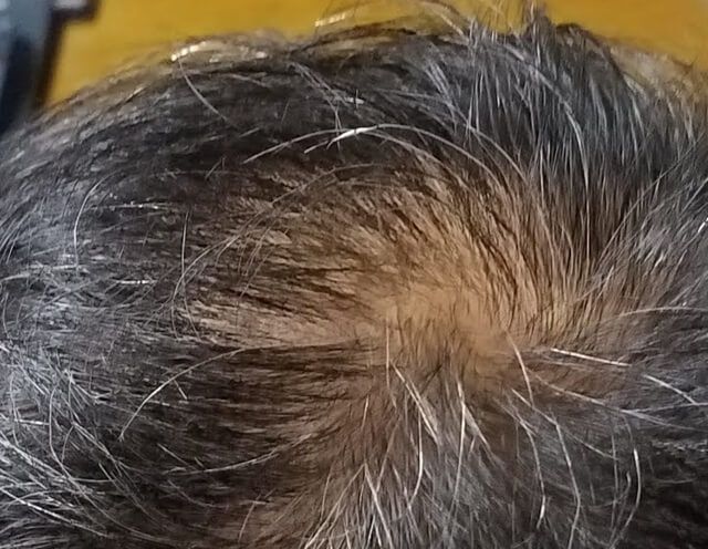 頭頂部が薄毛になりラリッチスカルプを使用した男性の口コミ