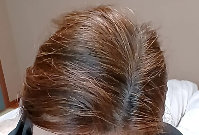 ビーリス白髪染め使用前（ビフォー）の頭頂部