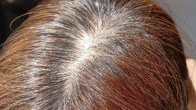 育毛剤リリィジュ使用前の薄毛画像