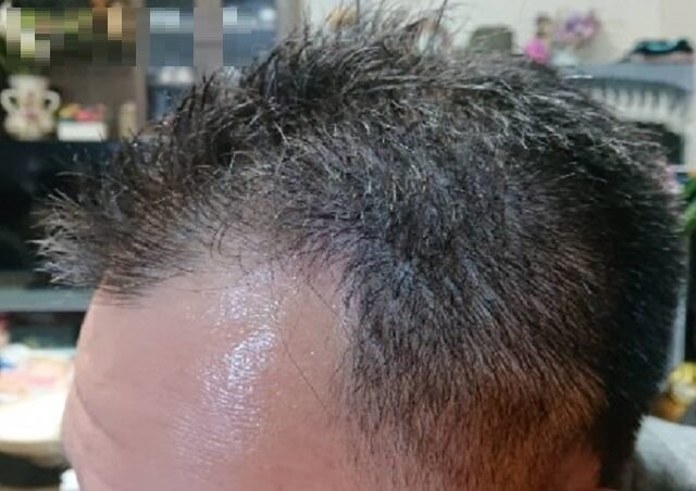 デュアセル3ヶ月使用し改善した頭頂部と生え際