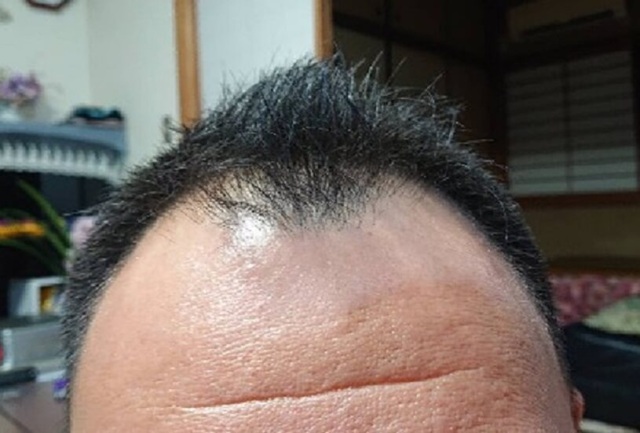 デュアセルを3ヶ月使用し改善した生え際