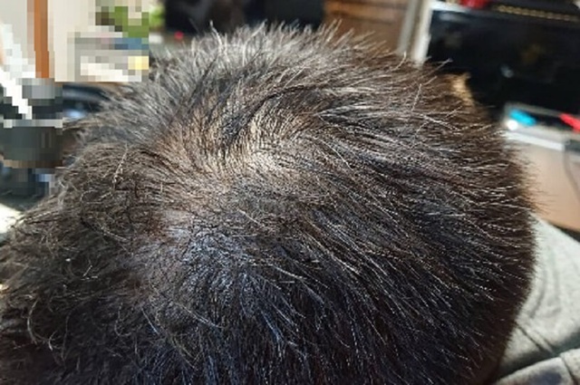 デュアセルを3ヶ月使用した体験談