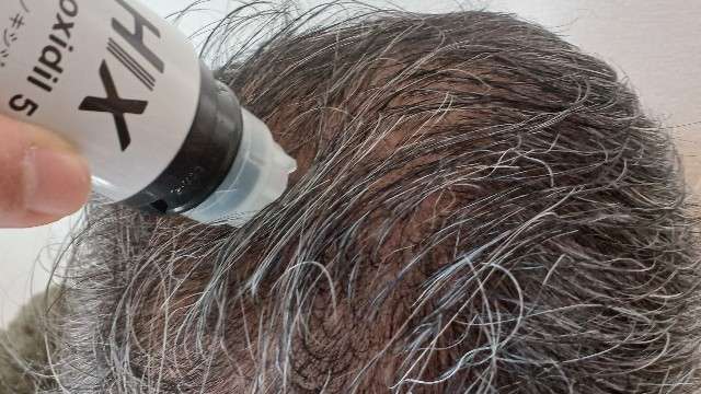 購入前に確認すべき副作用と「初期脱毛」の真実