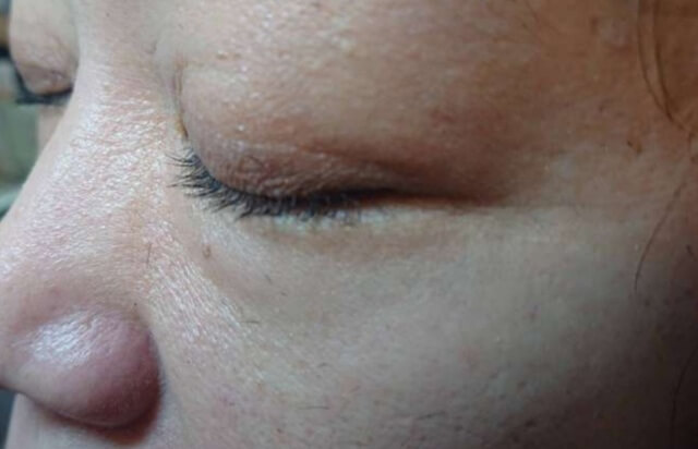 色素沈着した目元