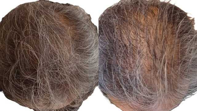 チャップアップ使用前後の毛量比較画像